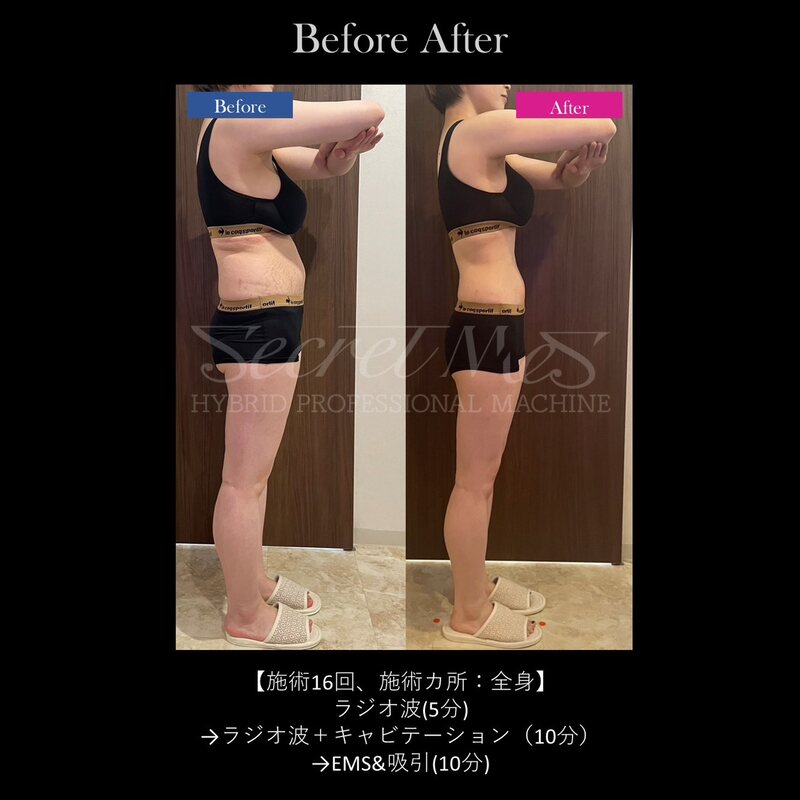 施術16回・背中とお腹のビフォーアフター