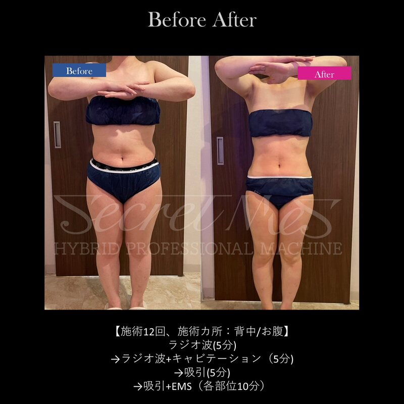 施術12回・背中とお腹のビフォーアフター